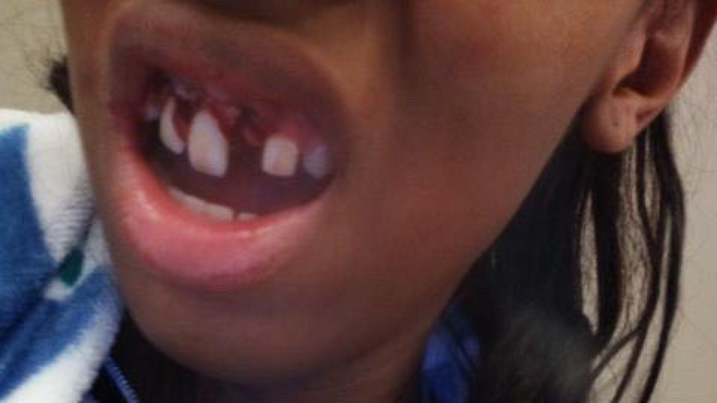 Help 17 year old Jazzya Fix Teeth and Gums After