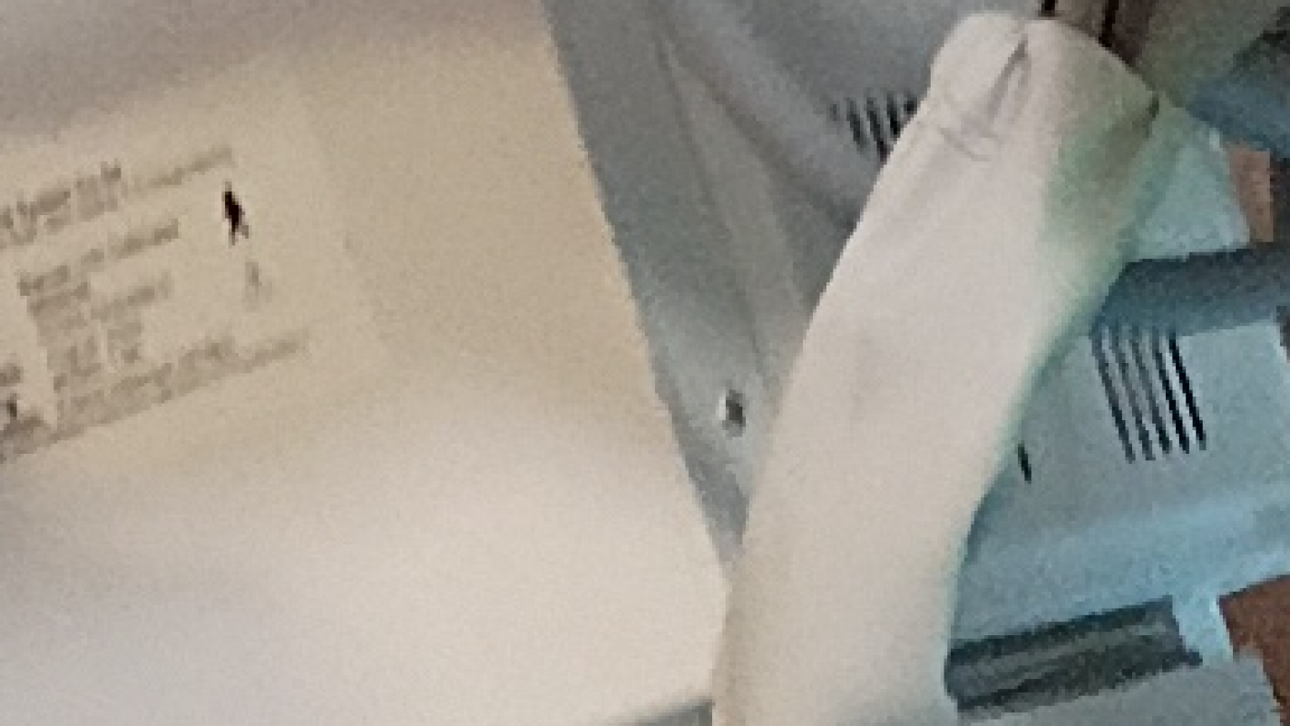 My younger brother needs help with the removal of the steel that is around his breast plate. After his 5th heart attack