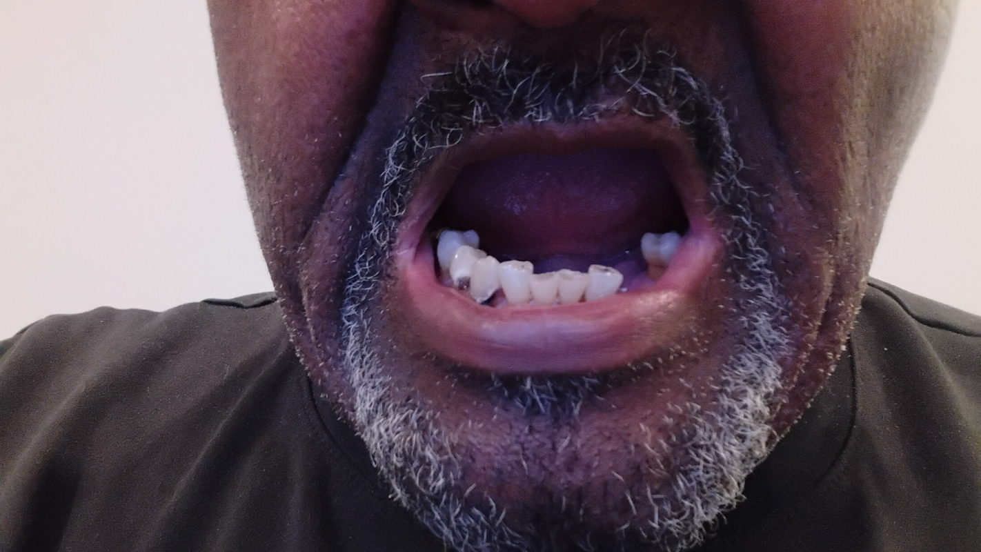 My Major Dental Implants