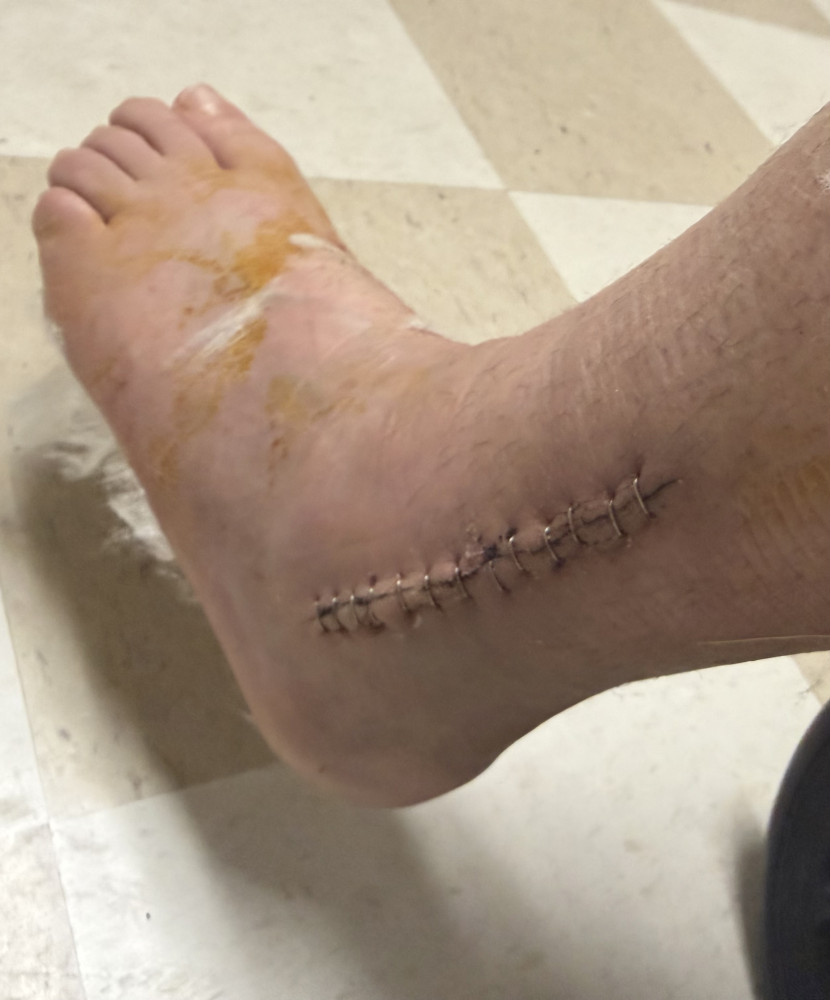 Staples out and cast on