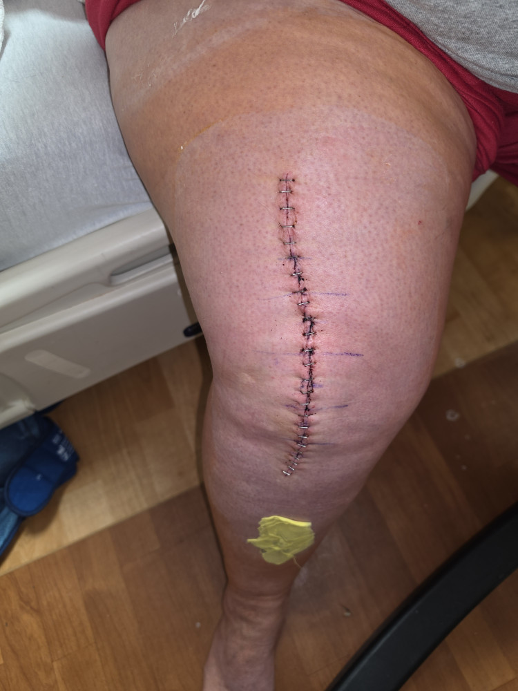 Surgery update