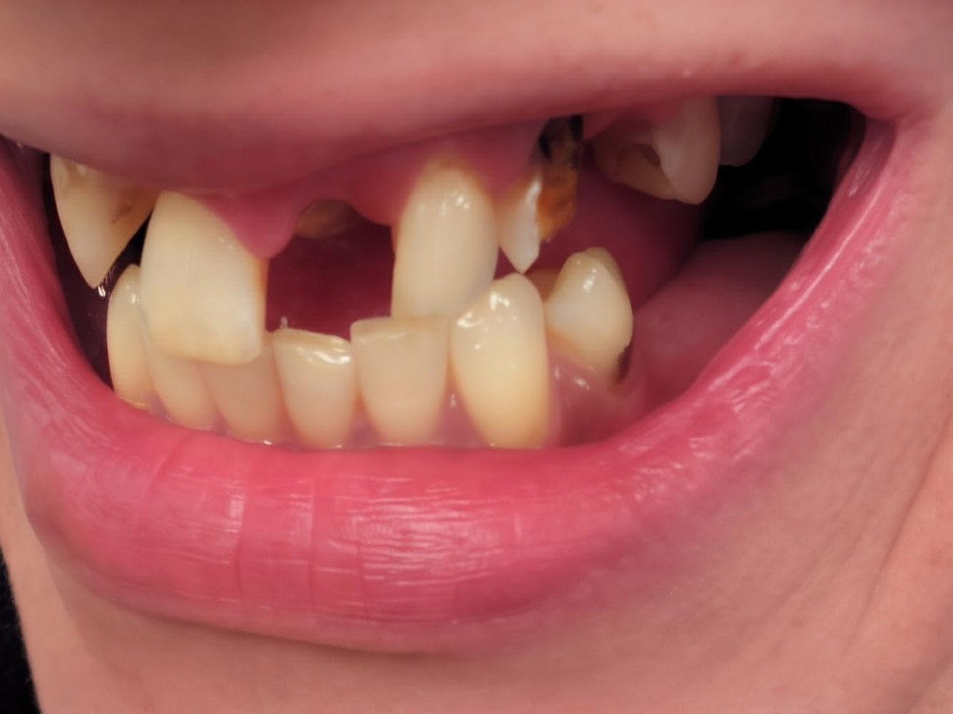 Another tooth broken 💔