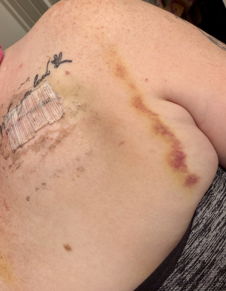 Healing is slow